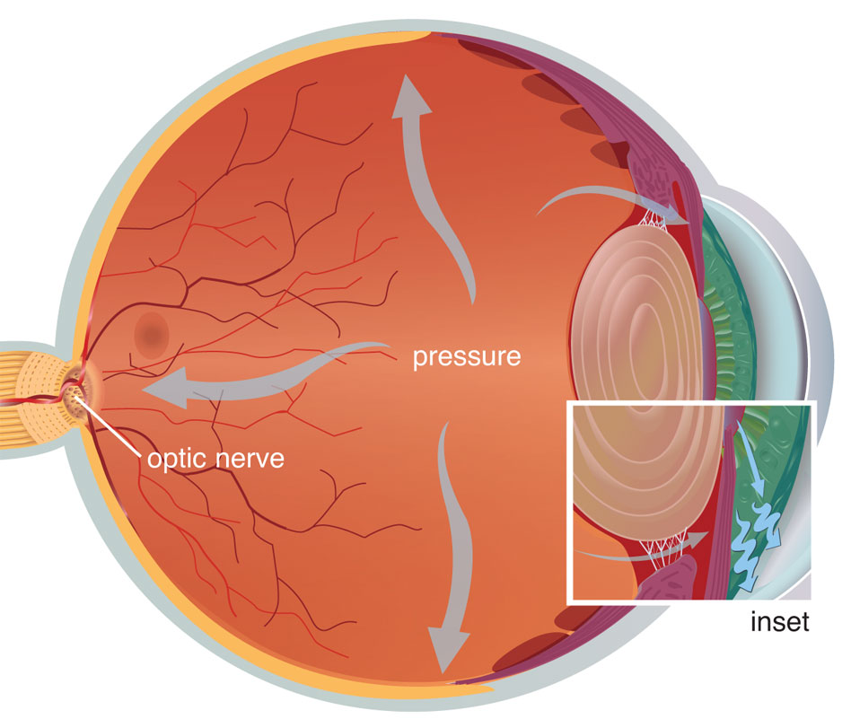 Glaucoma
