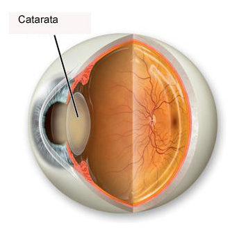 Cataratas