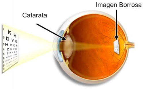 cataratas-oculares-ojos-diagrama